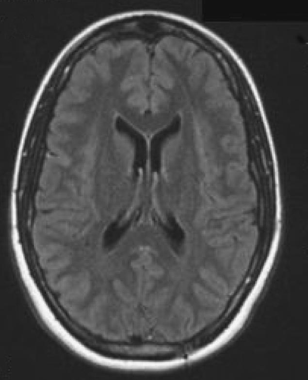 118 Bulletin of the NYU Hospital for Joint Diseases 2012;70(2):115-9 Figure 3 September 9, 2011. Surprisingly, during the next months, she did not experience any neurological deterioration.