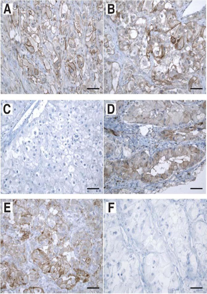 Discordant Tumor Cell PD L1 Expression Between Primary Kidney Cancer and Mets Primary Metastasis Discordance in 21% of