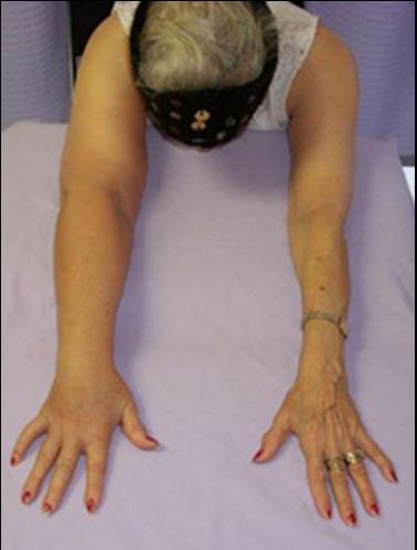 BREAST CANCER RELATED LYMPHOEDEMA Clinical guidelines strongly recommend patients against vigorous, repetitive or excessive upper body exercise Very conservative guidelines not based on