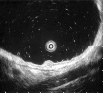 The role of Endoscopic Ultrasound in G-I NENs Type 1 and 2 gastric NENs: to evaluate the depth of invasion and indication to