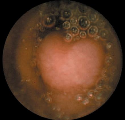 Role of wireless small bowel capsule endoscopy Indications : - To