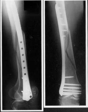 Fig 1 AP and lateral radiographs of the right thigh after stabilisation of the femoral fracture with the LISS plate On physical examination in the Accident and Emergency department, her right lower