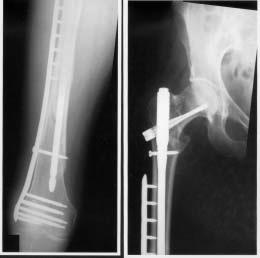 Fig. 3 Radiographs of the right hip and thigh after stabilisation of the right proximal femoral fracture with a cephalomedullary nail with the LISS plate in-situ.