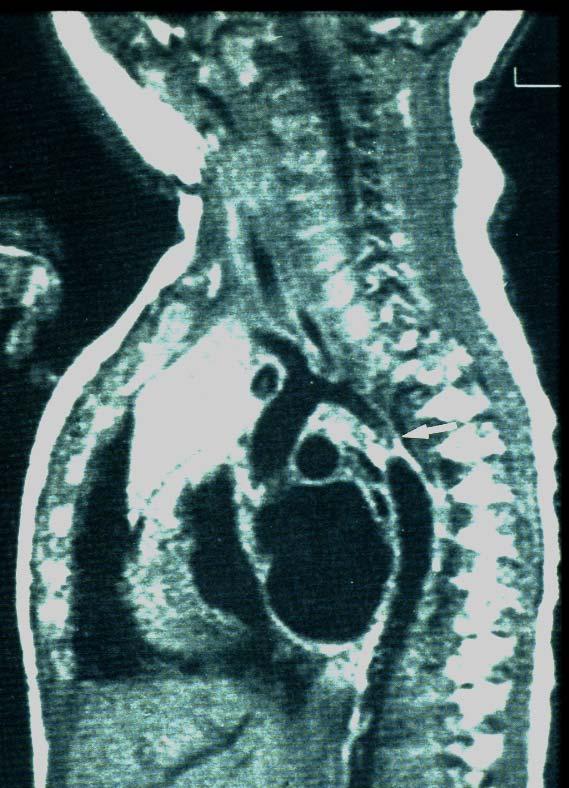 Coarctation of the aorta MRI best Image Blood