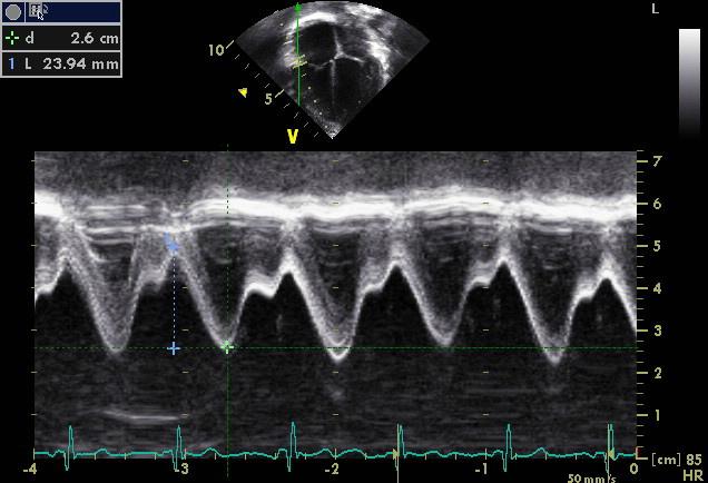 Echocardiography of adult congenital heart