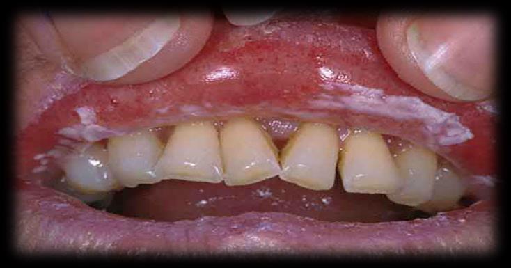 Fungal Oral/Perioral Oral Candidiasis Both of the following: Presence of raised