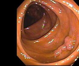 Sensitivity similar to colonoscopy (90% for cancers and 1cm polyps); About 20% will require colonoscopy follow-up when using 6mm as the detection threshold for polyps. May add costs to screening.