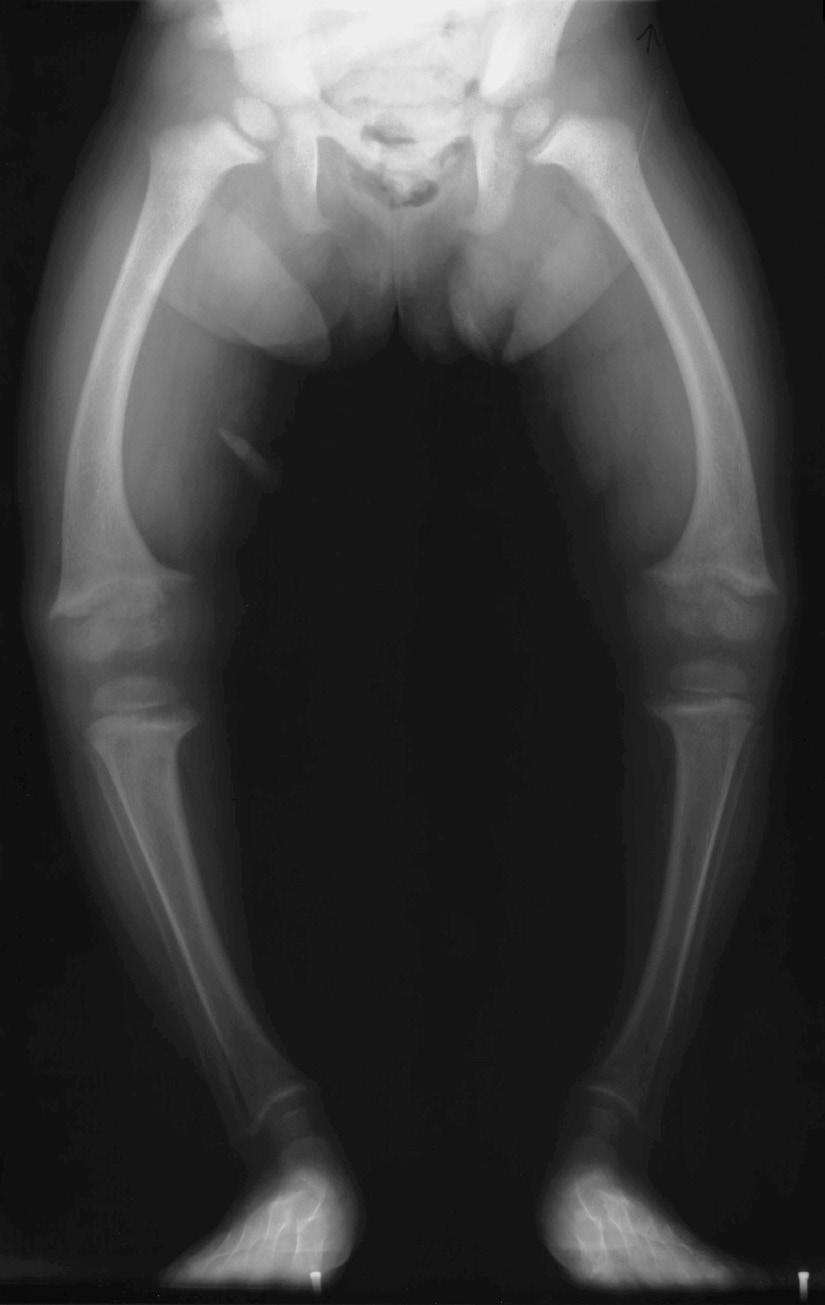 Figure 1. X-ray showing bone deformities associated with rickets. Image courtesy of Michael L. Richardson, M.D., University of Washington Department of Radiology Fresh milk has a high lactose content.