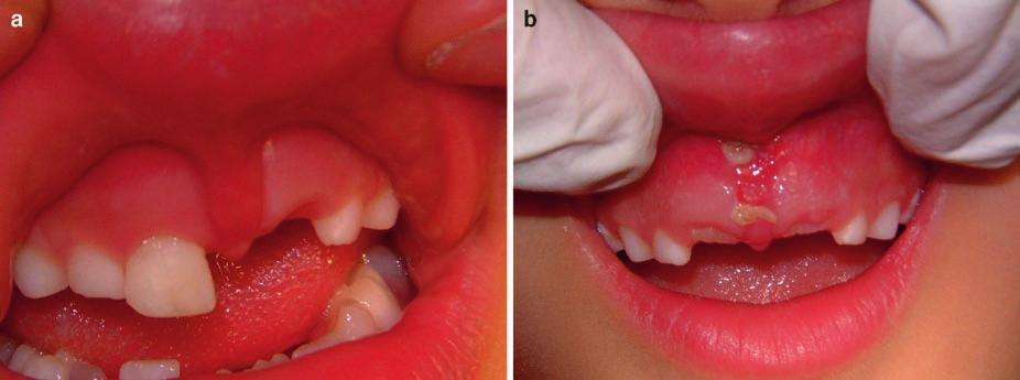 26 Clinical Oral Medicine and Pathology Fig. 2.25 Thick maxillary frenulum in a 5-year-old before (a) and after (b) surgical repositioning. similarly affect the facial aspect of the same teeth.