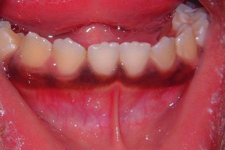 within the buccal mucosa due to the proximity of skin to the oral mucosa in this area.
