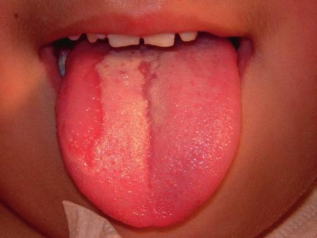 20 Clinical Oral Medicine and Pathology Fig. 2.8 Benign migratory glossitis in a child.