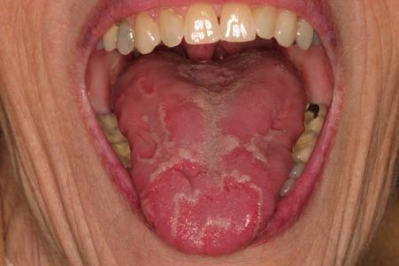 As this region of the tongue does not normally contain papillae, only the white rimmed borders are noted. 2.