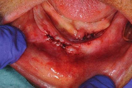24 Clinical Oral Medicine and Pathology The etiology of inflammatory papillary hyperplasia is poorly understood.