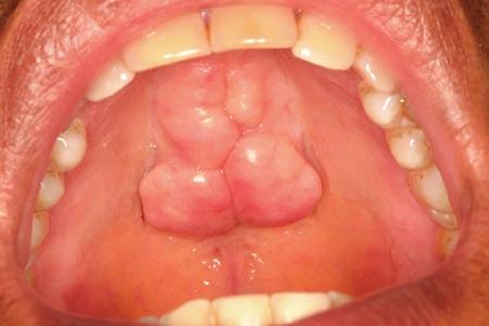 2.12 Ankyloglossia and Prominent Frenula the lingual aspect of the mandible inferior to the premolars bilaterally.