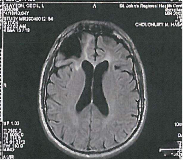 Case Example: Cecil Clayton In 1972, he was in a saw mill accident and 20% of his frontal lobe was removed Frontal lobe: Planning, impulse control,