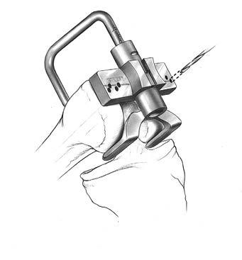 15 NexGen Cruciate Retaining and Revision Instrumentation Surgical Technique Figure 32 Figure 31 3 Figure 33 MICRO-MILL/5-in-1 Instrumentation Step One: Size the Femur Drill a hole in the center of