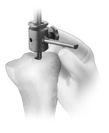 42 NexGen Cruciate Retaining and Revision Instrumentation Surgical Technique Figure 104 Figure 105 Cut Guide Intramedullary Technique To improve exposure of the tibial surface, use the tibial