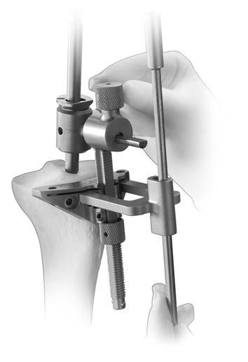 44 NexGen Cruciate Retaining and Revision Instrumentation Surgical Technique Figure 108 Figure 109 Step One: Position IM Alignment Guide (cont.