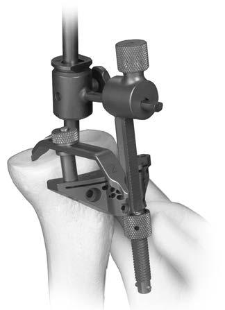 45 NexGen Cruciate Retaining and Revision Instrumentation Surgical Technique Figure 111 Figure 111a Figure 111b Figure 112 Figure 113 Step Two: Set Resection Level Each tip of the tibial depth