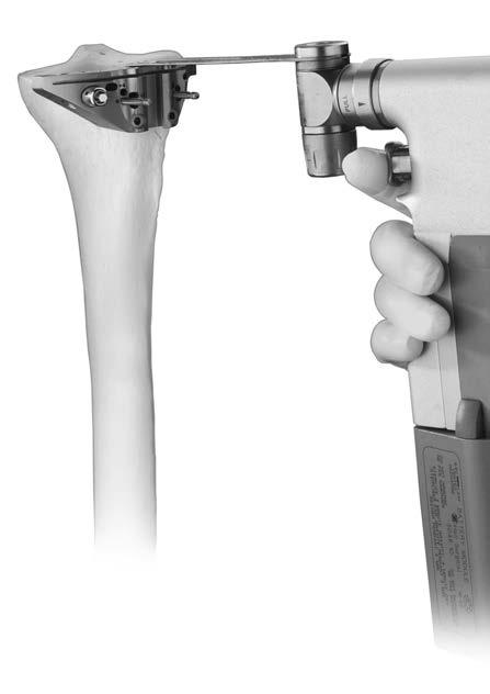 47 NexGen Cruciate Retaining and Revision Instrumentation Surgical Technique Figure 117 Figure 116 Figure 118 Step Three: Resect the Proximal Tibia (cont.