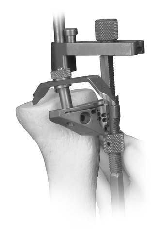 The 10 mm tip is used to check the depth from the least involved tibial condyle for an anatomic cut.