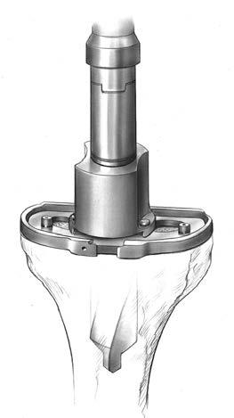 61 NexGen Cruciate Retaining and Revision Instrumentation Surgical Technique Drill for porous stemmed tibias only.