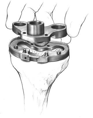 After drilling each hole, place a tibial holding peg in each to aid in stability (Figure 152).