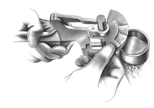 Squeeze the clamp until the anterior surface of the patella is fully seated against the fixation plate (Figure 163). Note: Patella reamers that use the pilot drill can also be used.