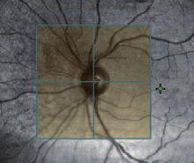 glaucoma detection and management LSO provides an exquisite