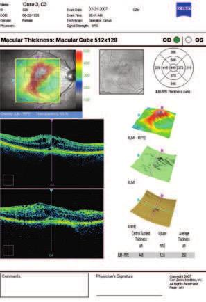 At a Glance: Critical Details Macular Thickness Report Patient Name Slide Navigator enables a simultaneous view of a selected point on LSO image, OCT fundus image, HD thickness map, HD layer maps,