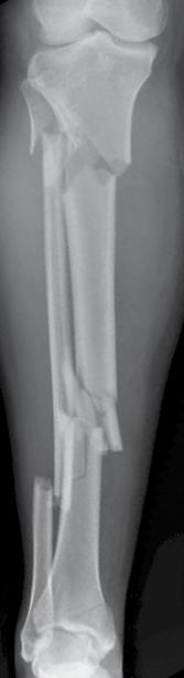 Case 4: Tibia Patient information 44-year-old female Closed segmental tibia fracture with
