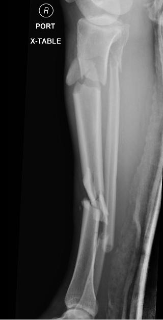 closed fracture of the right lower extremity after being struck by a car at high speeds.