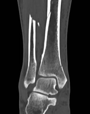 Challenges The patient sustained a comminuted segmental tibia fracture with a closed