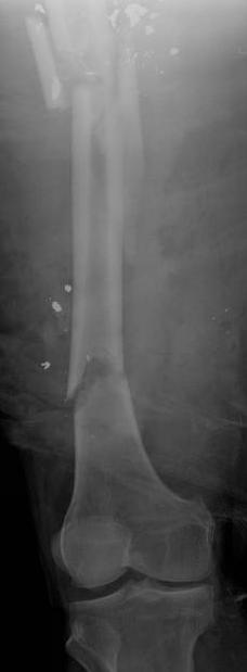 Case 1: Femur Patient information 50-year-old male Segmental femur fracture with comminuted proximal and simple transverse distal fracture.