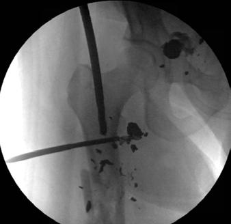 Solution Performed ORIF of the distal femoral segmental fracture.