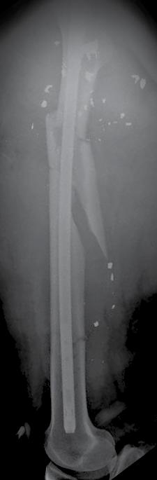 7mm Strength Plate to maintain and reduce the distal fracture (Figure 4).