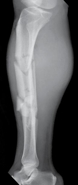 Case 2: Tibia Patient information 45-year-old male Type IIIA open segmental tibia fracture Case information This patient was struck by a motor vehicle traveling at unknown speed.