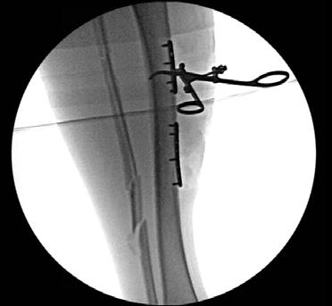Solution The proximal and distal fractures were anatomically reduced using two 2.4mm Strength Plates to obtain length, alignment and rotation (Figure 11).