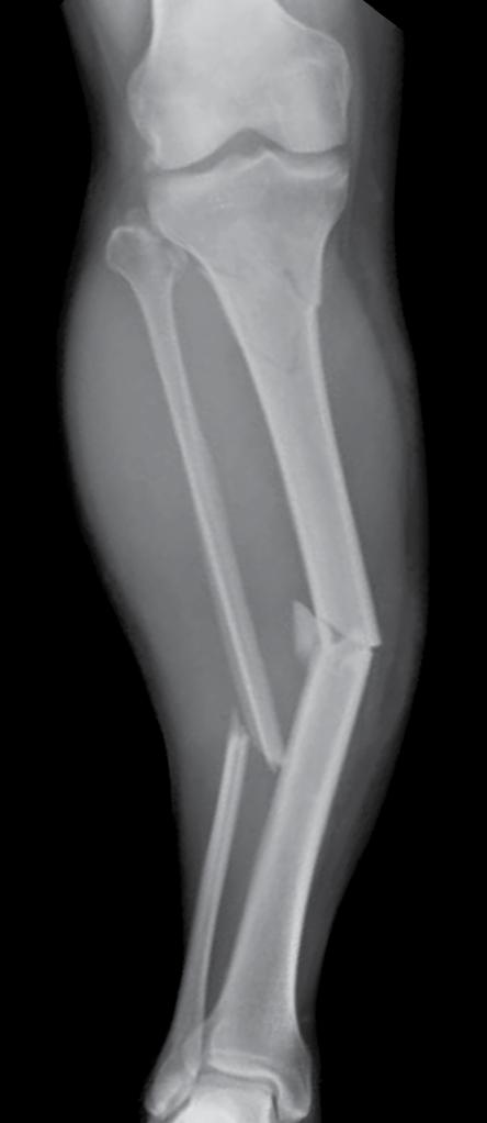 Case 3: Tibia Patient information 43-year-old male Closed segmental right tibia and fibula fracture Case information This patient sustained a 9