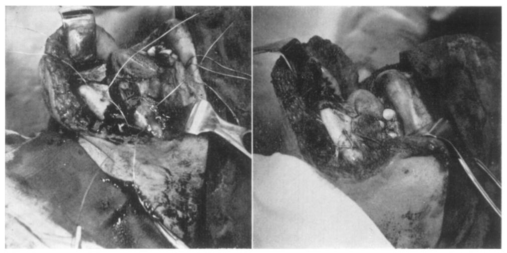 Wound cleaned. Eyelet wires and intermaxillary fixation loosely applied. Fig. 5.--Case I. Fig. 6.--Case I. FIG. 5 FIG. 6 Interosseous lower border wires placed. Mandibular fragments reduced.
