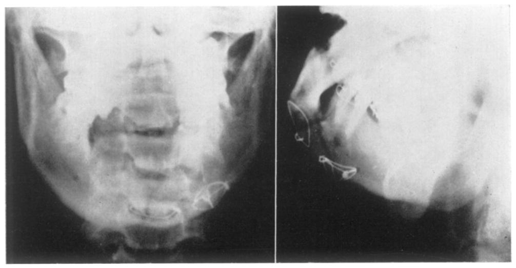 Nineteenth post-operative day. Post-operative Progress.--Post-operative radiographs showed satisfactory position of the fragments (Fig.