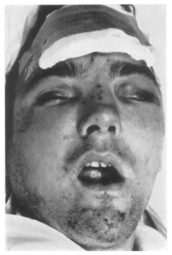 --This patient was also knocked off a bicycle by a motor car. He was admitted to a nearby hospital and given emergency treatment before transfer to Wythenshawe Hospital the following day. FIG.