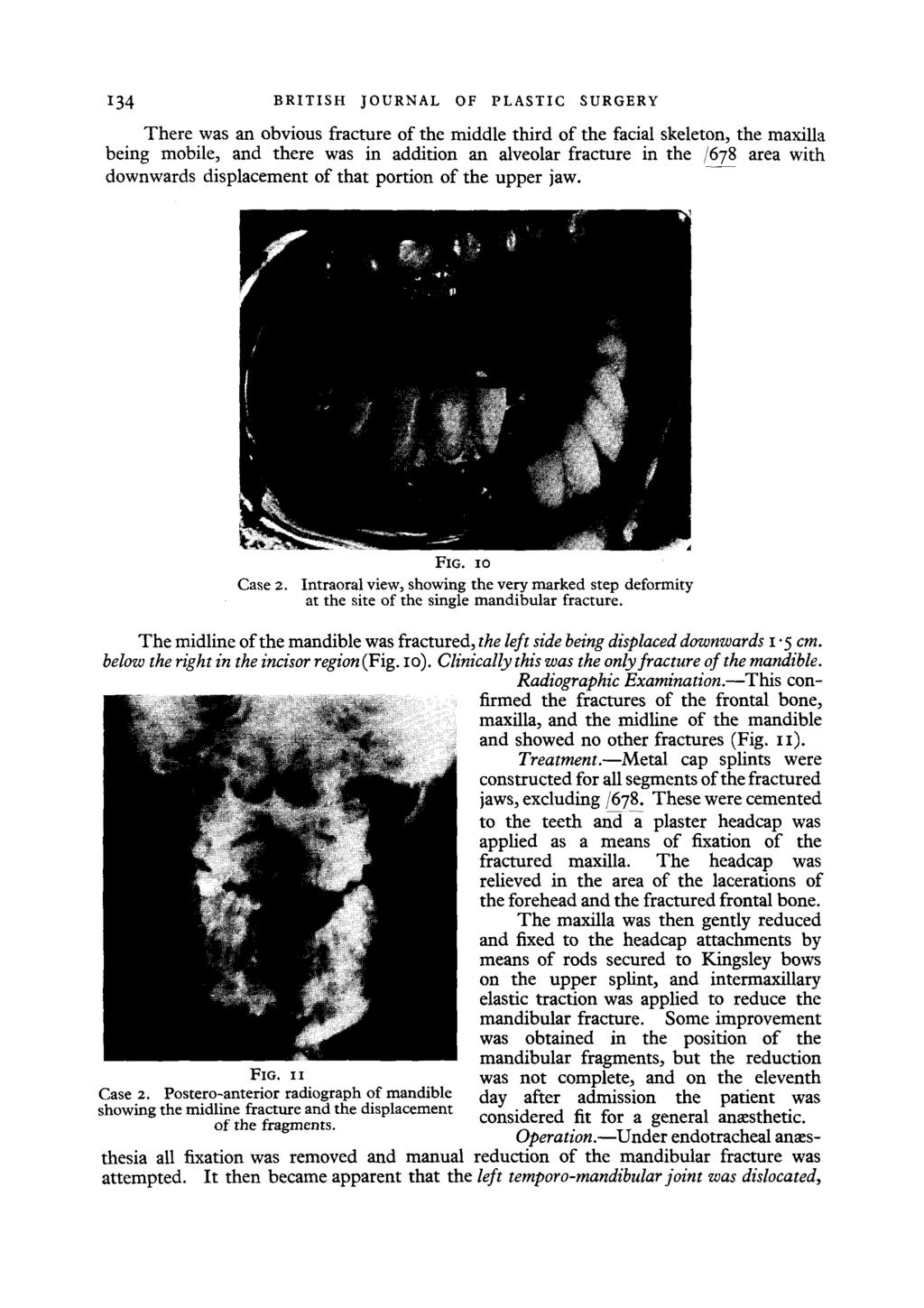 i34 BRITISH JOURNAL OF PLASTIC SURGERY There was an obvious fracture of the middle third of the facial skeleton, the maxilla being mobile, and there was in addition an alveolar fracture in the /678