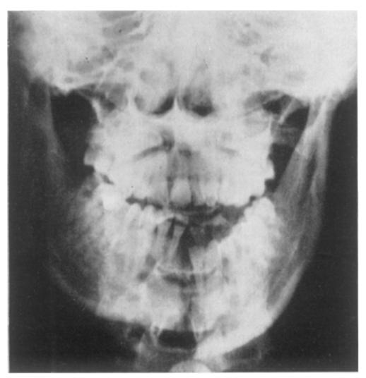 The midline of the mandible was fractured, the left side being displaced downwards I "5 cm. below the right in the incisor region (Fig. IO). Clinically this was the only fracture of the mandible.