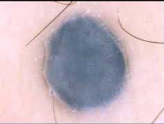 Blue white structures Pigmented melanophages or melanocytes of the