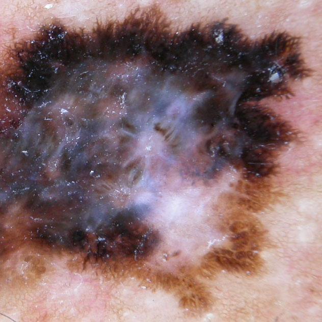 dermoscopic finding of invasive melanoma.