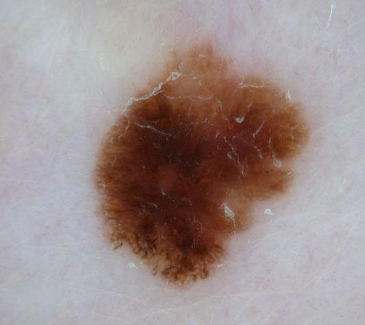 Melanoma in Situ Asymmetry of color and/or