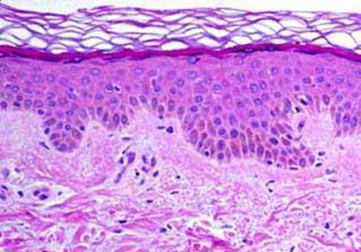 Normal Skin Layers Stratum Corneum Epidermis Papillary Dermal Junction Dermis