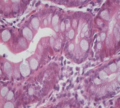 Mature and immature intestinal metaplasia was observed in 11 cases and was characterized by progressive replacement of the gastric epithelium with an