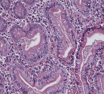 Mature type intestinal metaplasia, Col H-E, x400 The epithelial dysplasia was observed in 9 samples, 6 of which were low grade dysplasia.